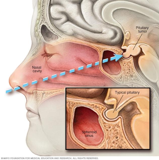 Transnasal transsphenoidal surgery