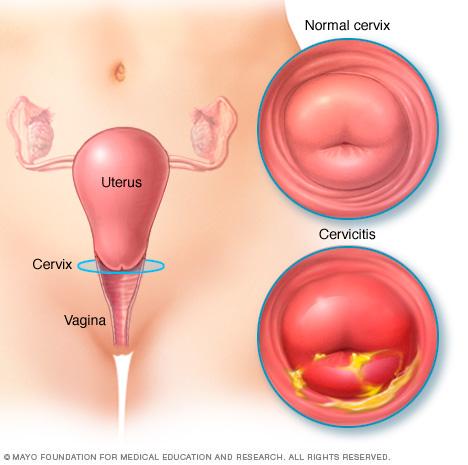 Illustration of normal cervix and cervix with cervicitis 
