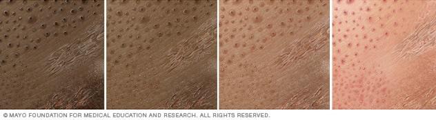 Contact dermatitis on four different skin colors.