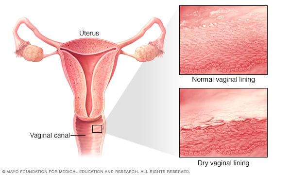 Healthy vaginal lining vs. dry vaginal lining