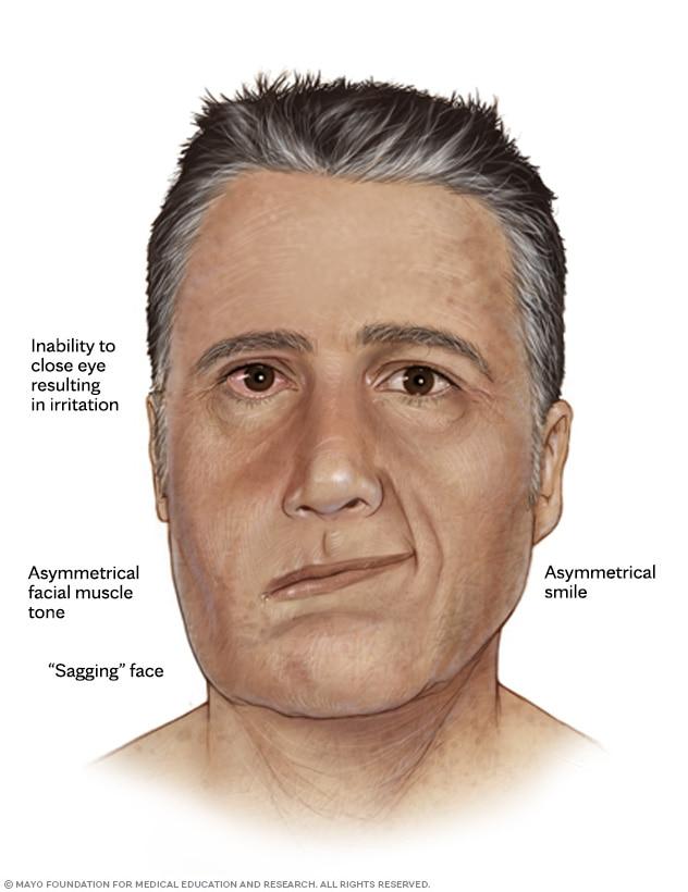 One side of the face doesn't move like the other side and droops, including the corner of the mouth and eyelid