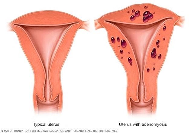 Illustration shows side-by-side a typical uterus and a uterus with adenomyosis tissue deposits
