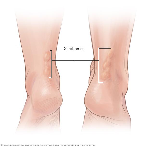 Cholesterol deposits on the Achilles tendon called xanthomas