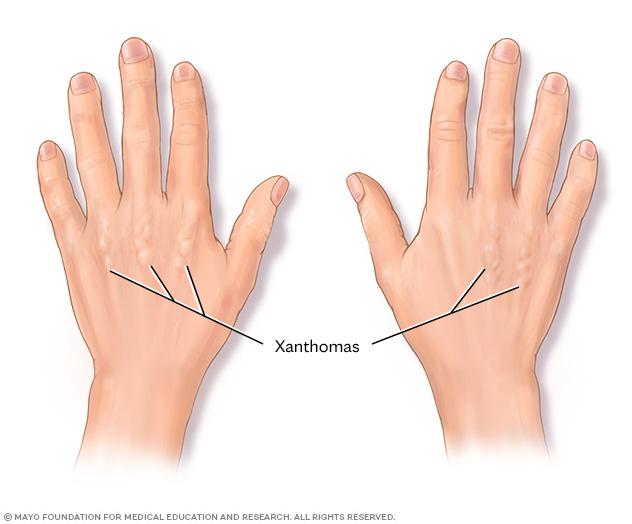 Cholesterol deposits on the hands called xanthomas