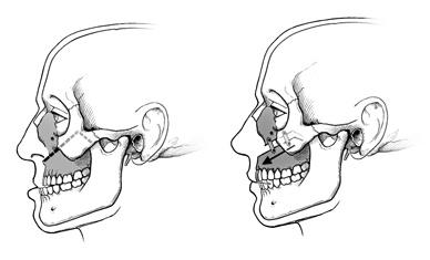 In upper jaw surgery, the surgeon makes cuts in the upper jaw, moves it forward, backward, up or down as needed and secures it with plates and screws. 