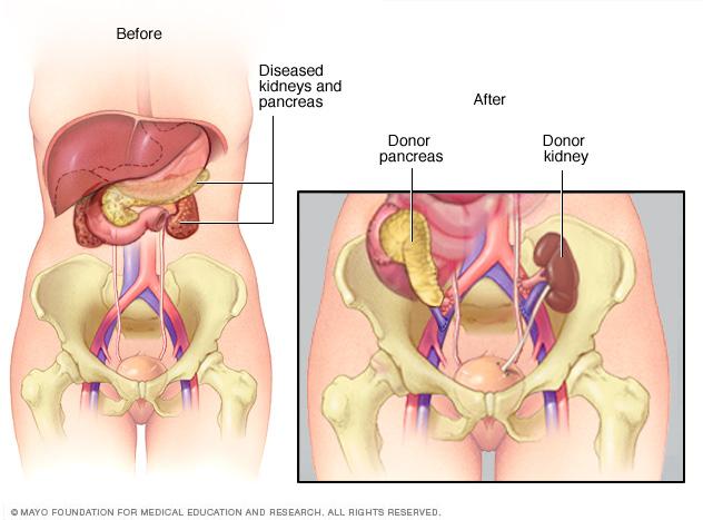 Transplanted pancreas and kidney 