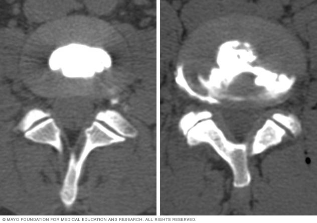 Images comparing how dye looks in normal and damaged spinal disks. 
