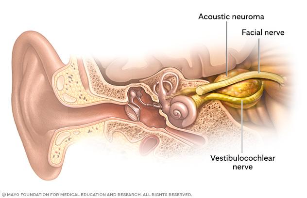 Acoustic neuroma and facial and vestibulocochlear nerves
