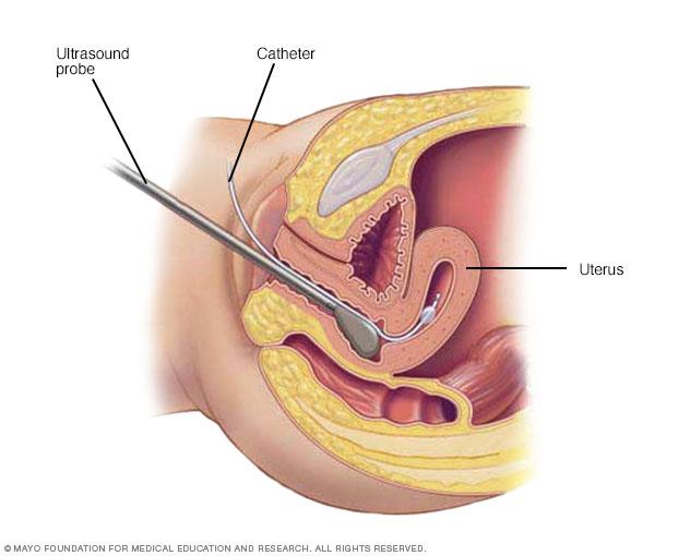 Illustration showing what happens during a sonohysterography procedure