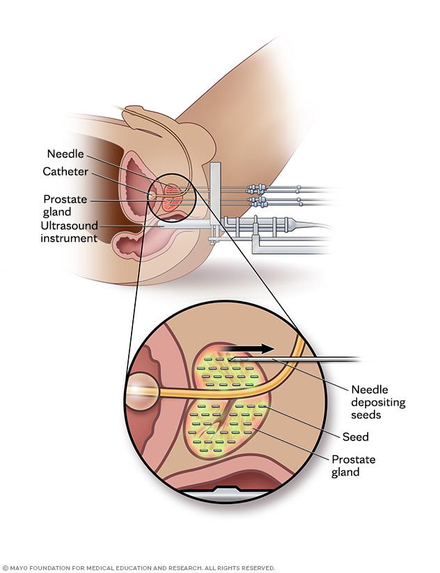 A needle deposits many tiny radioactive seeds inside the prostate