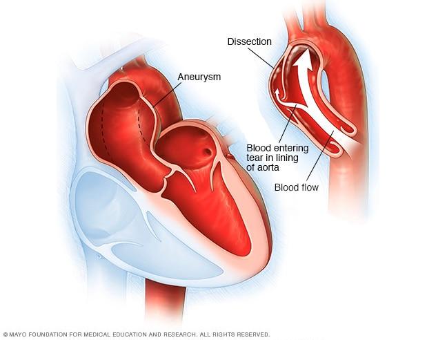Illustration showing aortic dissection and aortic aneurysm