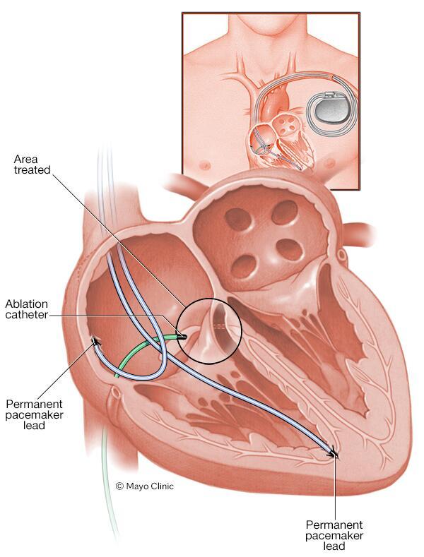 A heart during AV node ablation