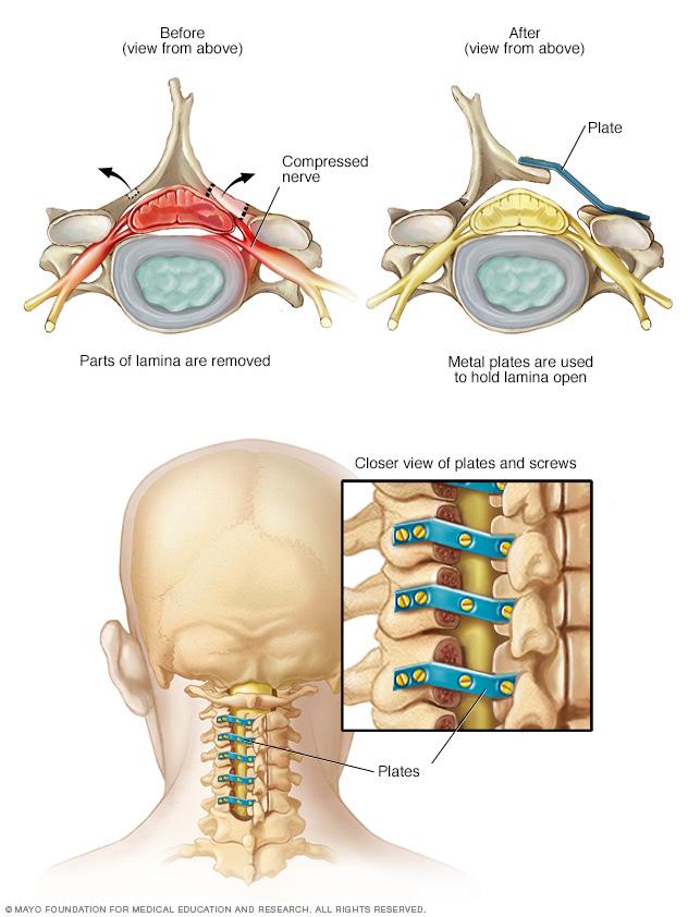 Illustration of laminoplasty