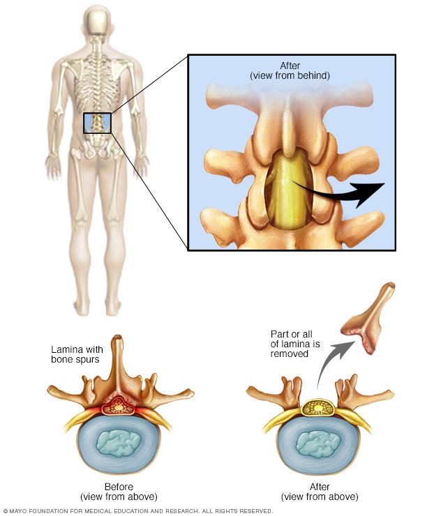 Illustration of laminectomy