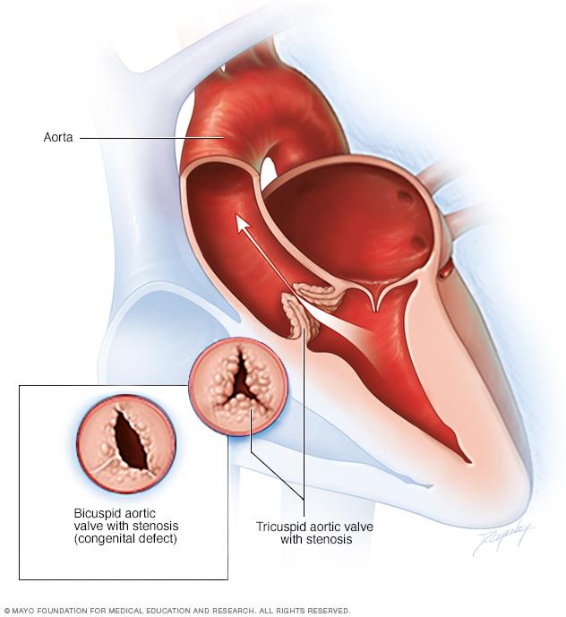 Illustration showing aortic valve stenosis