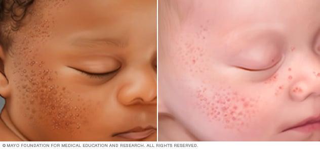 Baby acne on different skin colors.
