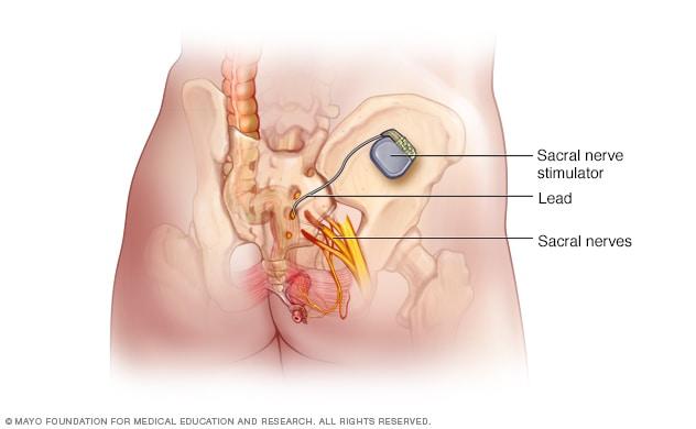 Implanted nerve stimulation device