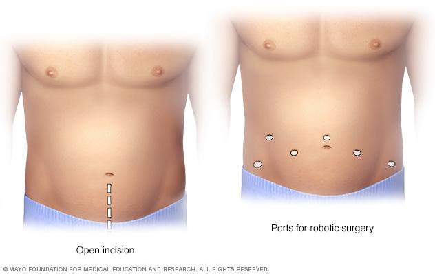 Location of incisions for open prostatectomy compared with incisions for robotic prostatectomy