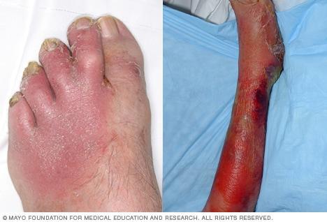 Untreated cellulitis can develop from a mild condition to a severe one.