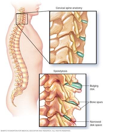 : Illustration showing cervical spondylosis