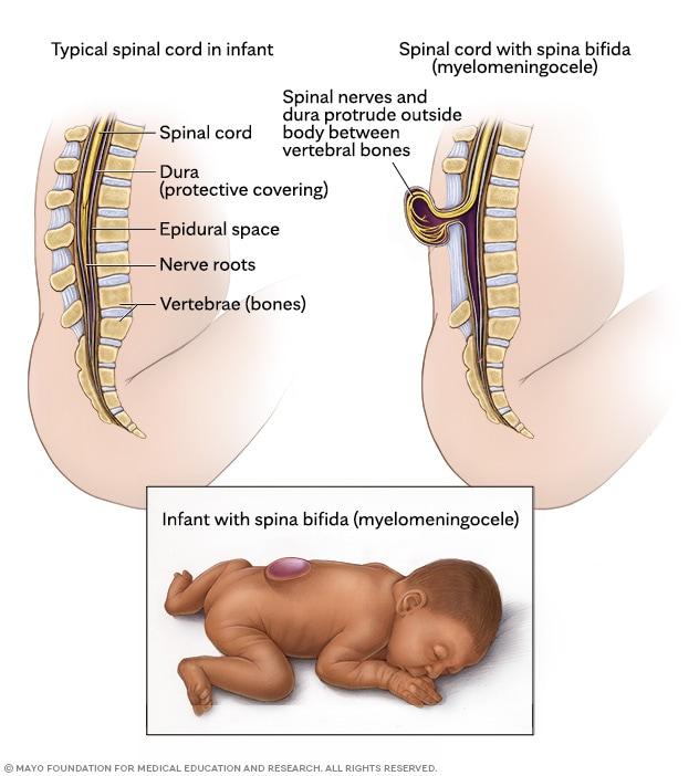 Illustrations showing typical spinal cord and spina bifida