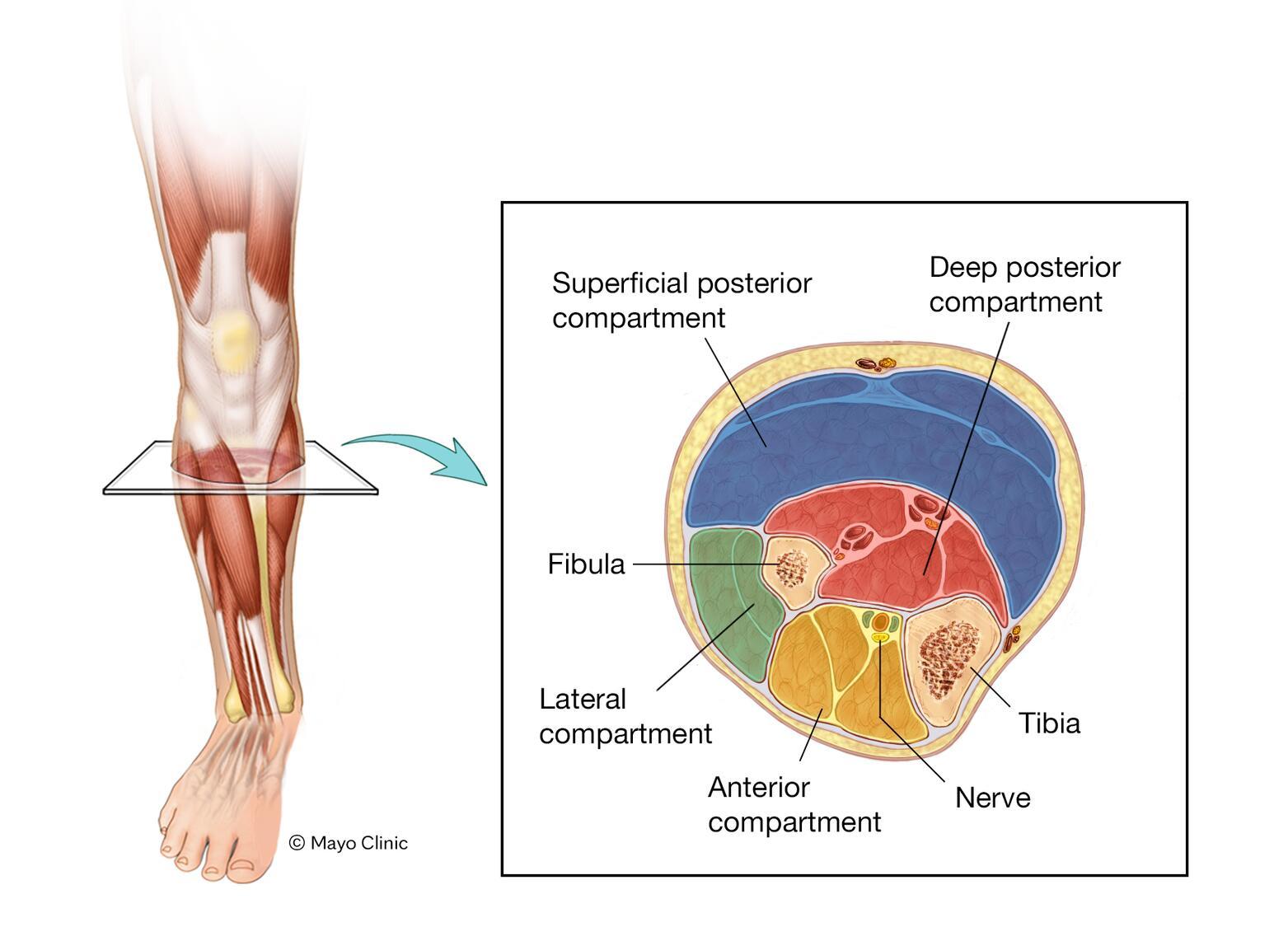 Chronic exertional compartment syndrome