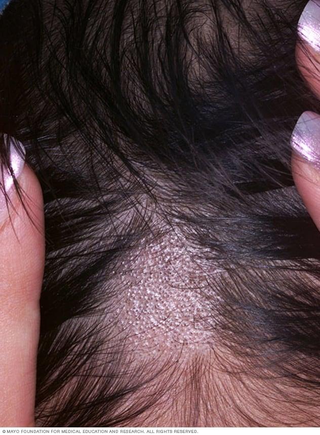 Close-up image of ringworm of the scalp