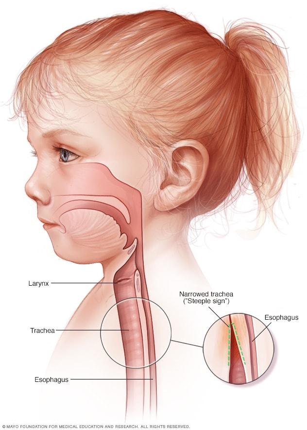 A child with croup