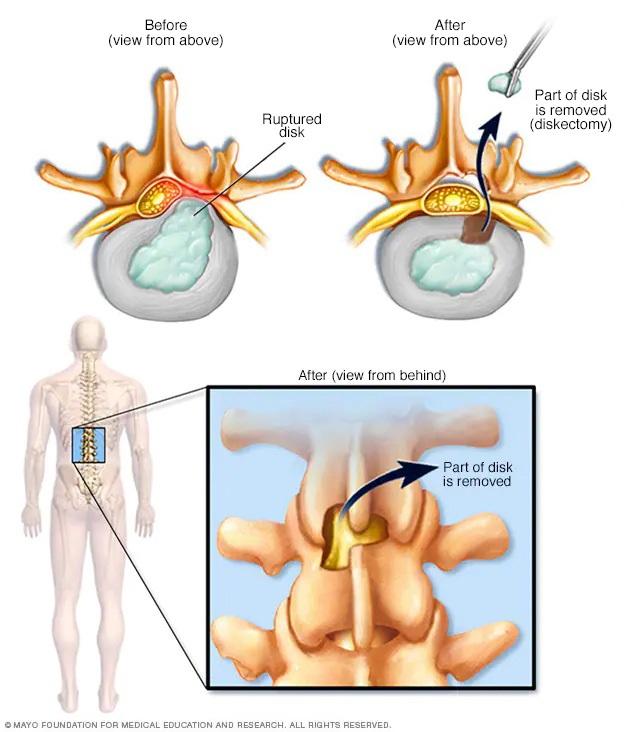 Illustration showing removal of herniated portion of spinal disk