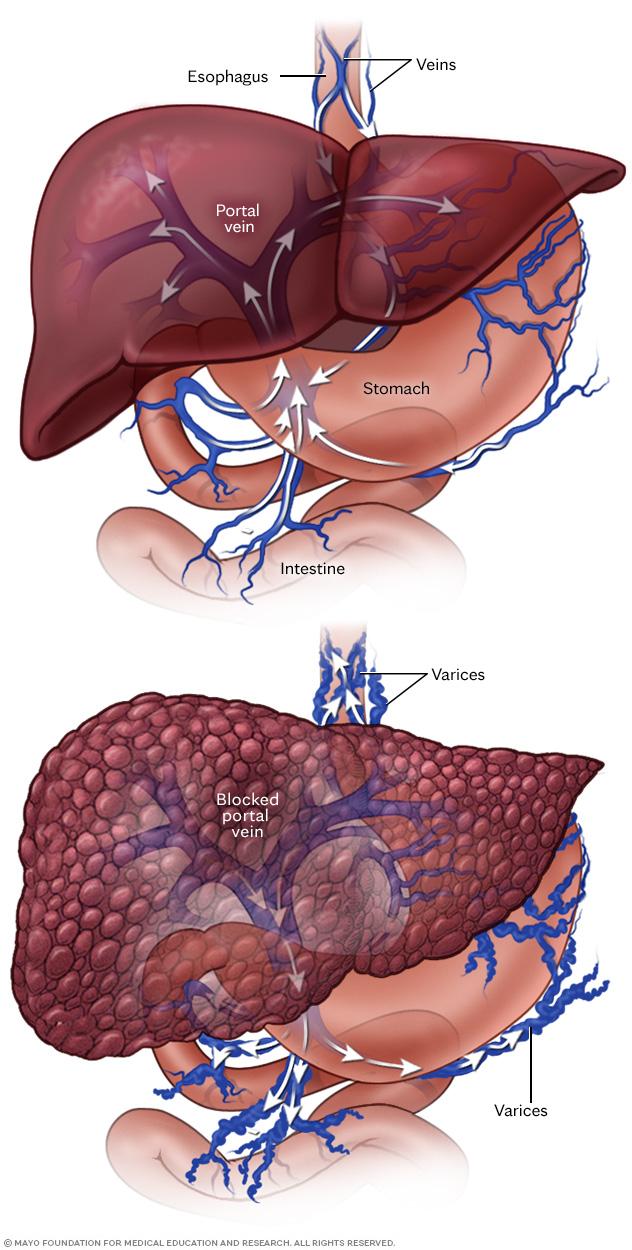 Typical liver blood flow versus portal hypertension