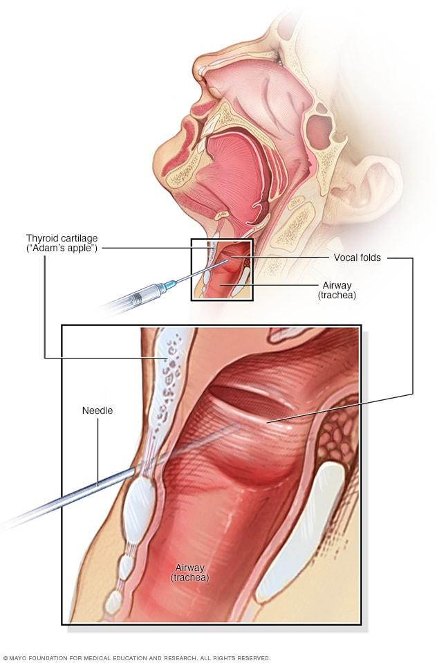 Botox injections in the neck