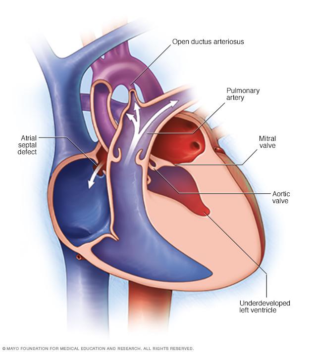 Illustration showing hypoplastic left heart syndrome