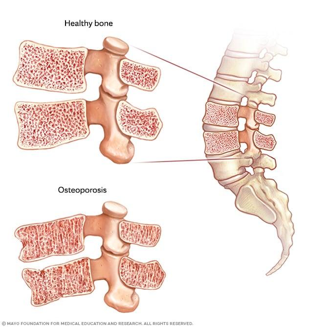 Healthy bone and weakened bone