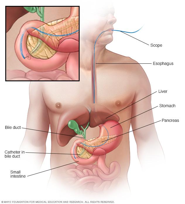 Illustration of a scope passing through the esophagus to place a catheter into the bile duct near the pancreas