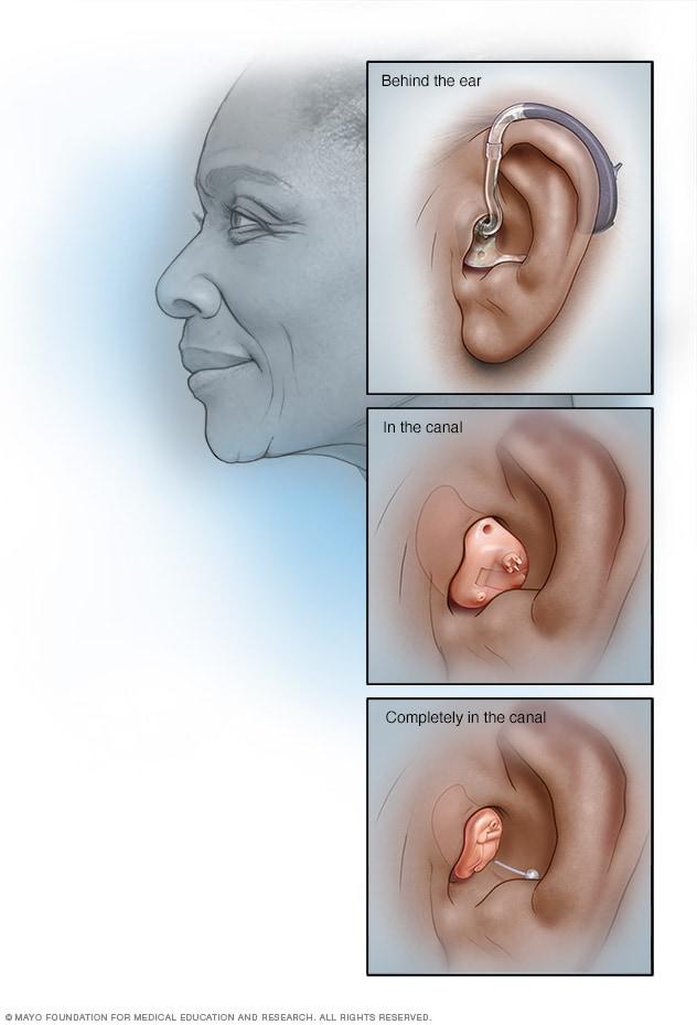 Common hearing aid styles