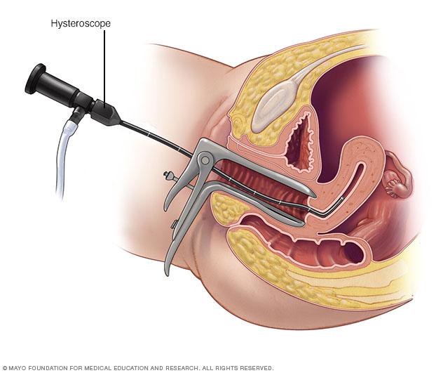 Illustration showing hysteroscopy