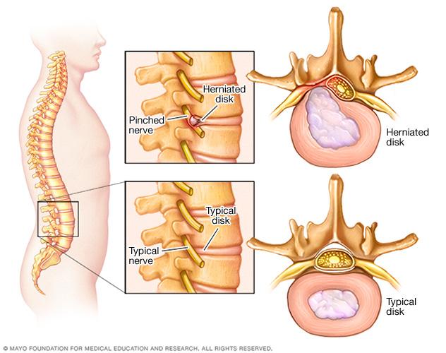 Pinched nerve in spine