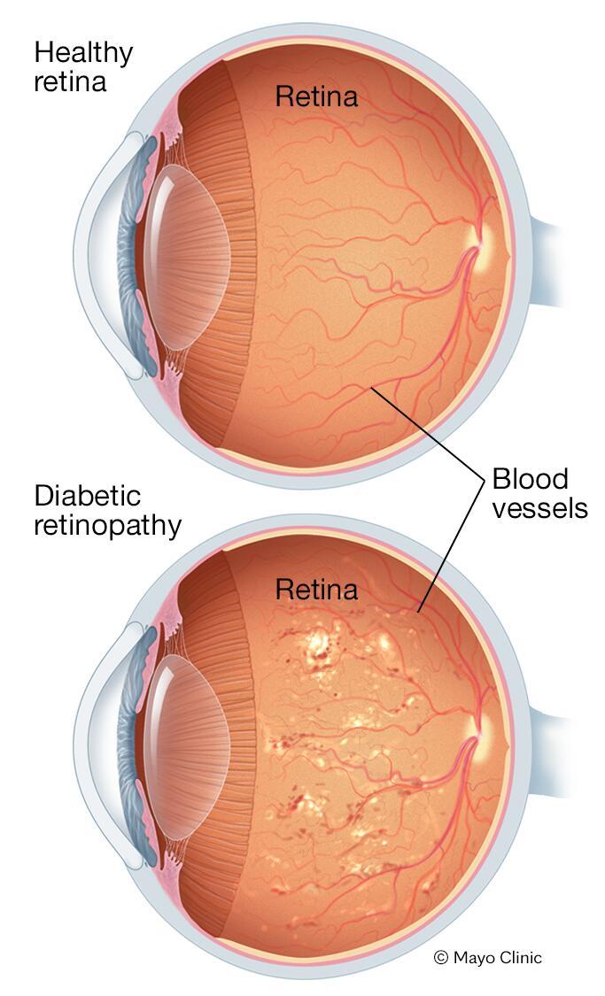Illustration showing severe nonproliferative diabetic retinopathy
