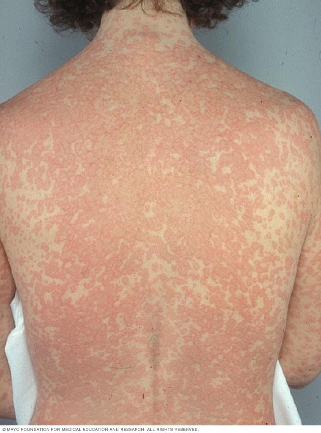 Rash caused by drug allergy