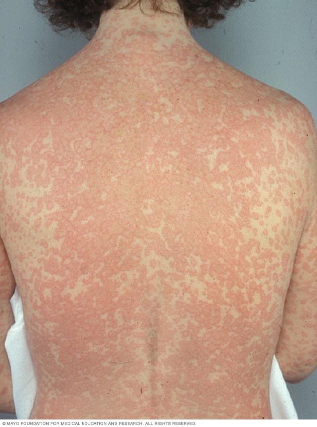 Image of rash caused by drug allergy
