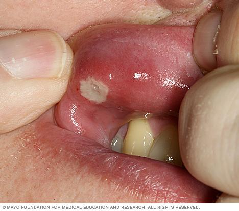 White canker sore on inside of upper lip.