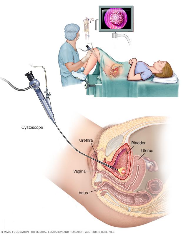 Female cystoscopy exam