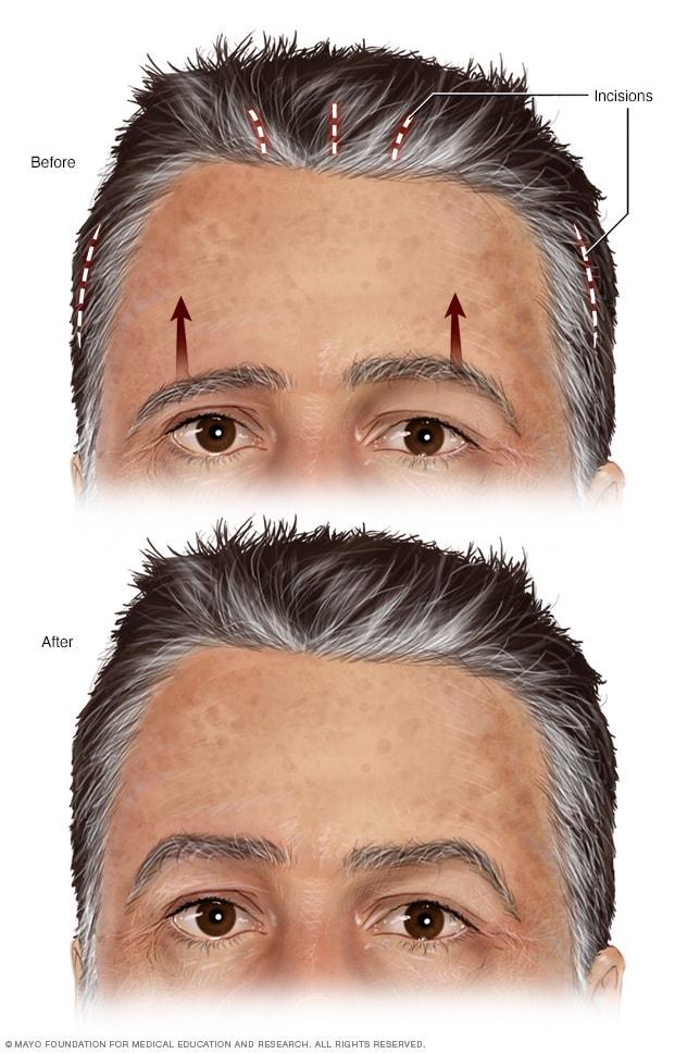 Brow lift