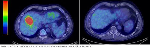 A tumor in the liver