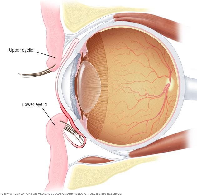 Illustration showing entropion