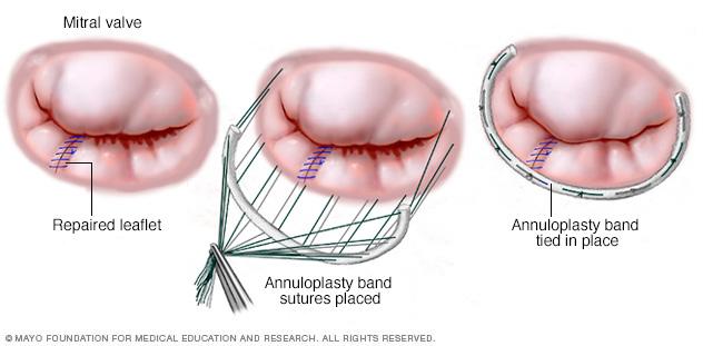 Mitral valve annuloplasty