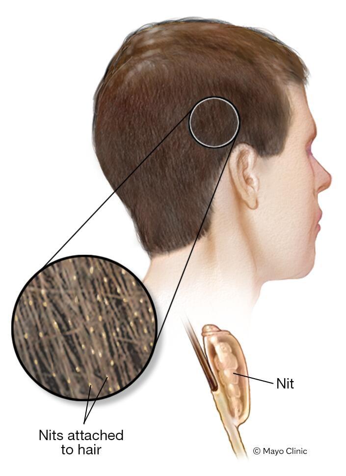 Illustration showing nits on hair