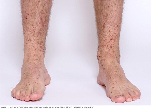 Image showing Henoch-Schonlein purpura