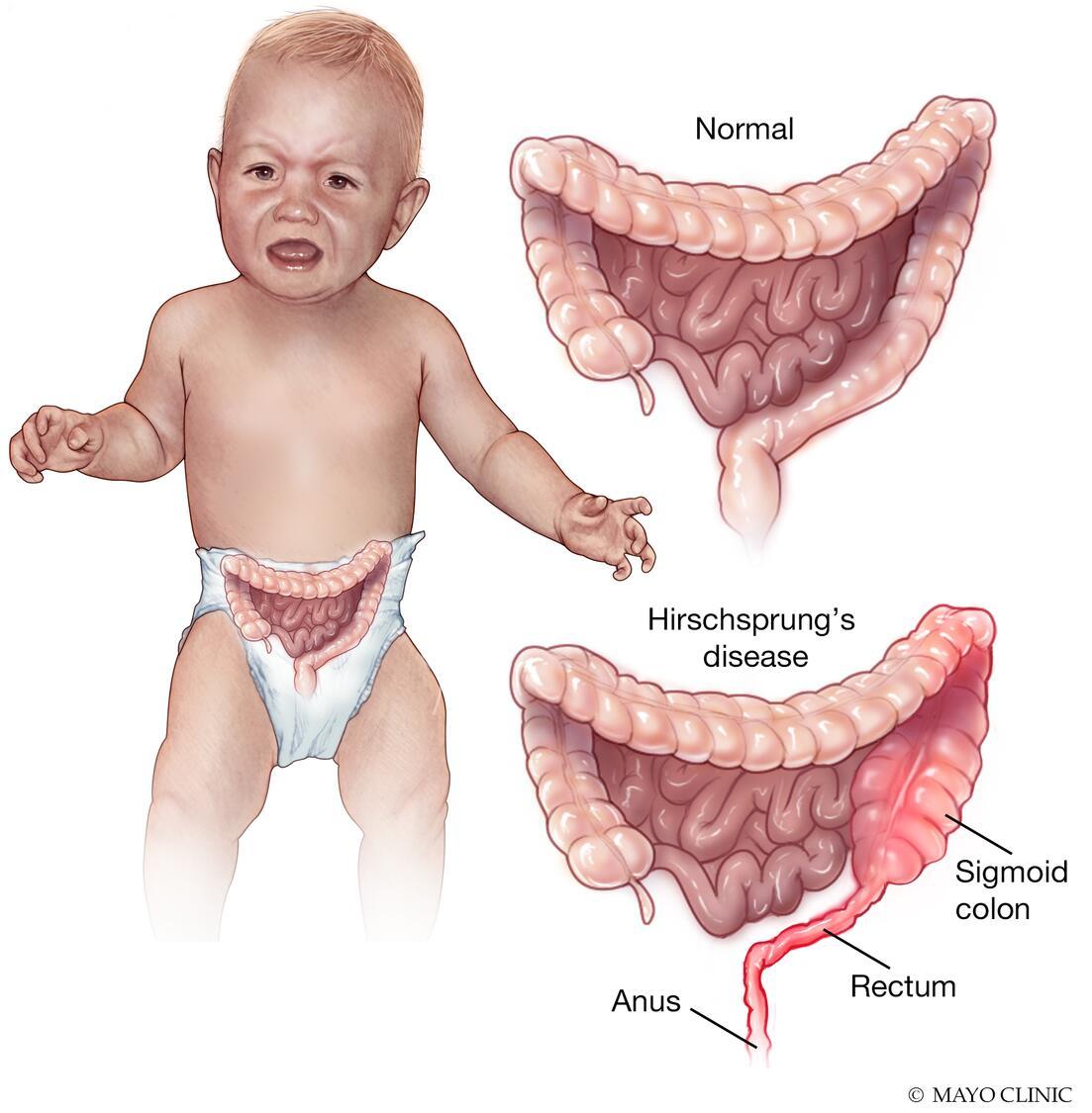Illustration showing a typical colon and rectum and with Hirschsprung disease
