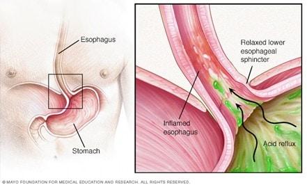 Illustration showing how GERD occurs in the esophagus